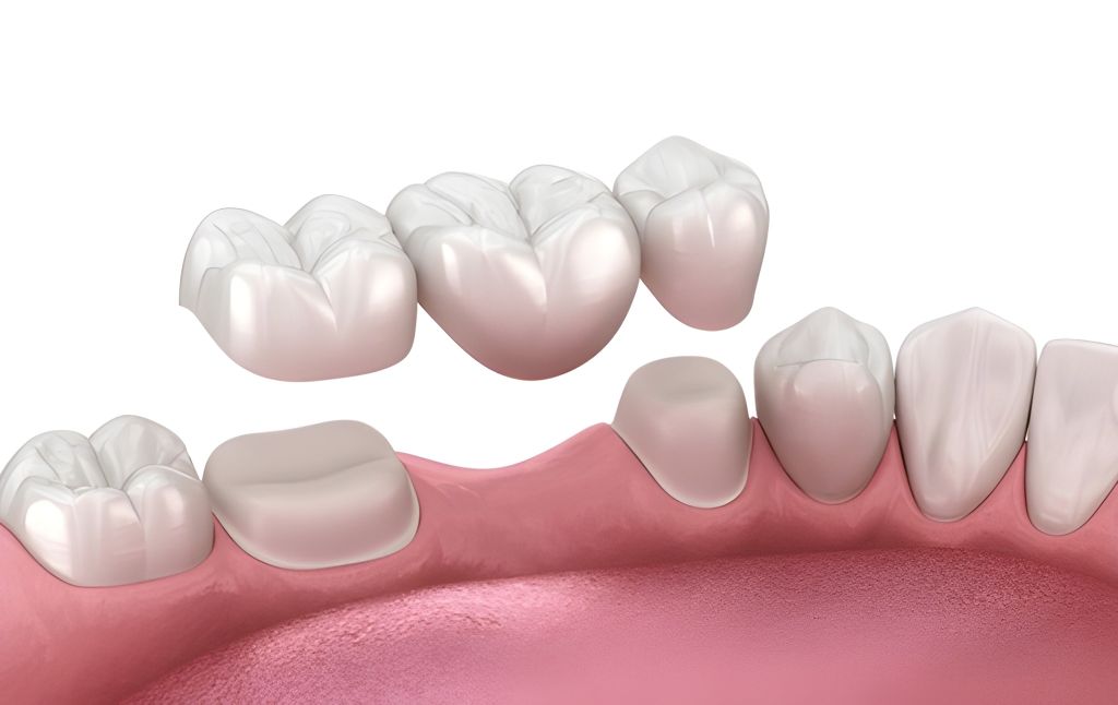 bridging the gap with professional dental bridges near you