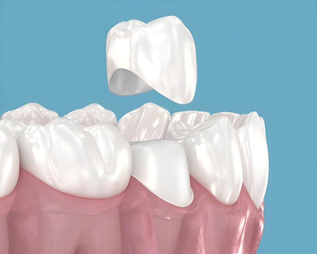 dental crowns in brampton on