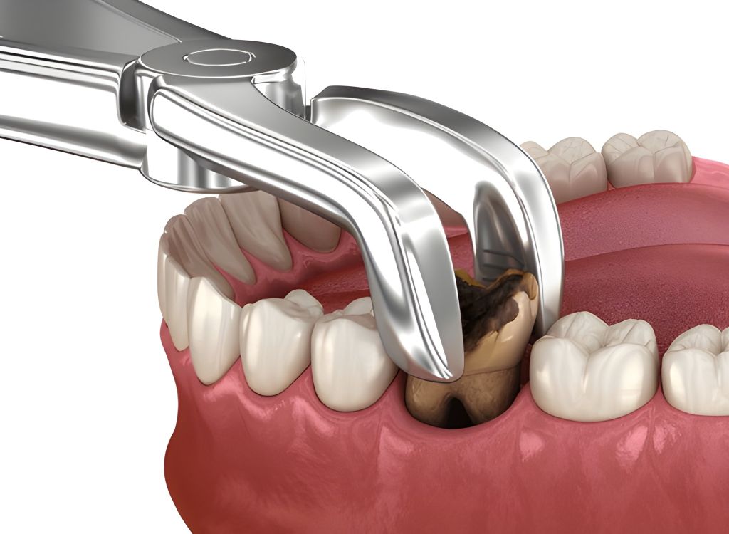 gentle care for professional tooth extractions near you