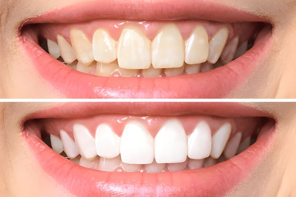 zoom teeth whitening in brampton on