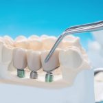 dental bridges compare to implants