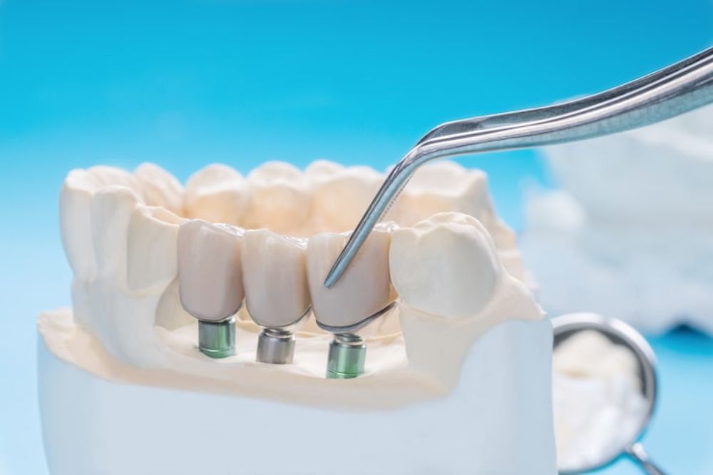 dental bridges compare to implants